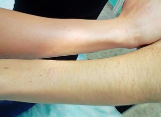 Электроэпиляция летом Электроэпиляция летом