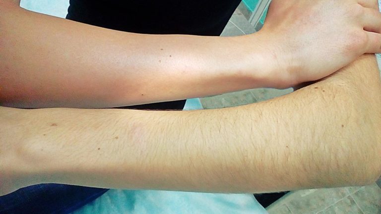 Электроэпиляция летом